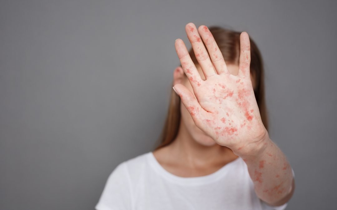 Can Measles Cause Longterm Complications?