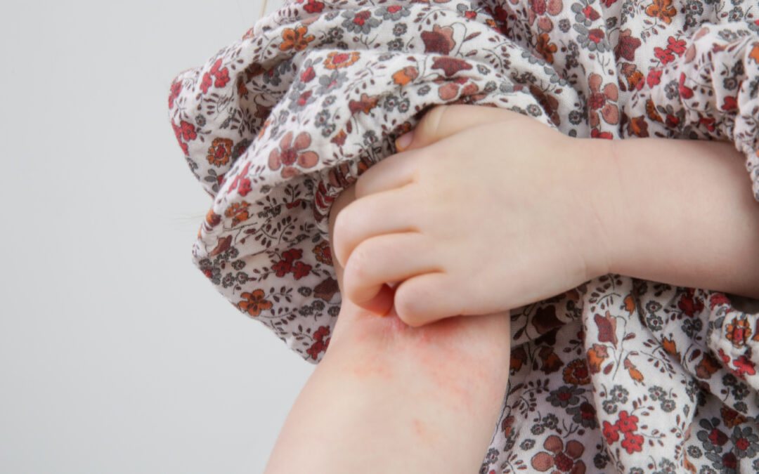 Identifying Poison Ivy on Kids